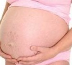Pregnancy Stretch Mark Removal Peoria