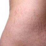 Stretch Mark Removal Westminster CO